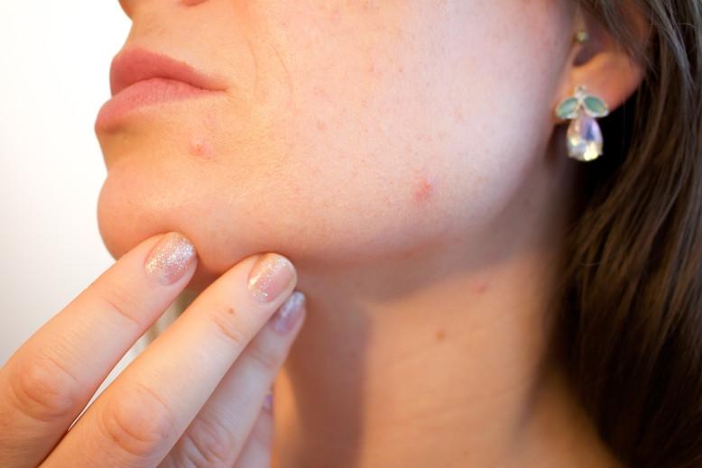 acne and health skin deep professional