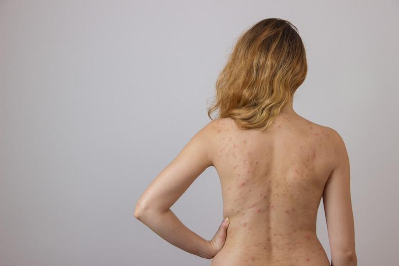 back acne treatments skin deep alameda
