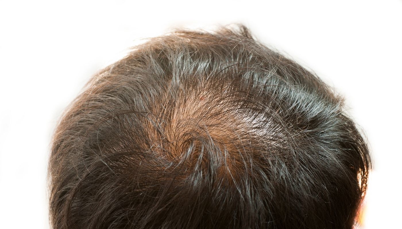 Close-up of thinning hair and visible scalp, ideal for showcasing Nutrafol for Men results.