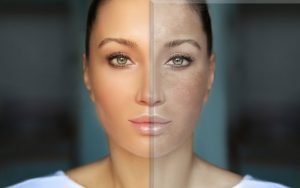 Woman’s face split: one side clear, other shows melasma and skin discoloration.