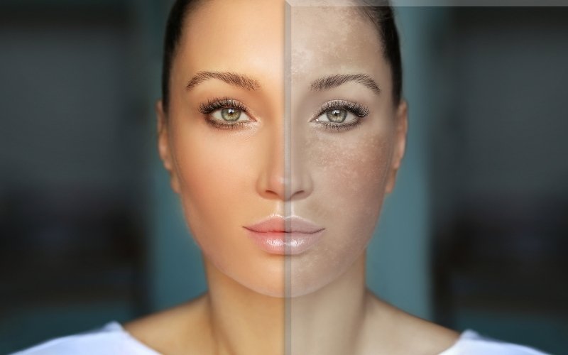 Woman’s face split: one side clear, other shows melasma and skin discoloration.