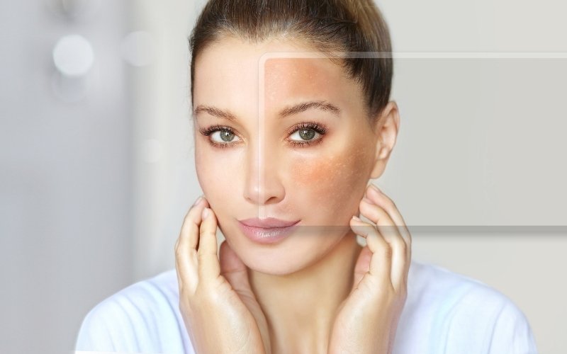 Woman with even skin tone on one side and dark spots from hyperpigmentation on the other.