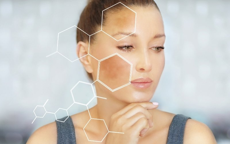 Woman with melasma and hyperpigmentation on her cheek